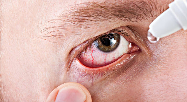 Средства для лечения аллергии на глазах и веках