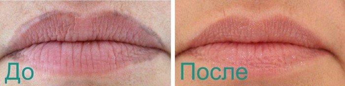 фото фото до и после удаления перманетного макияжа лазером