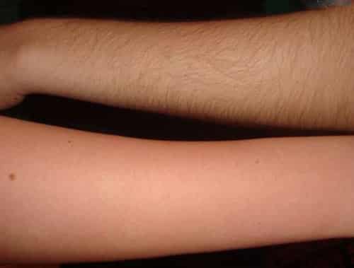 До и после эпиляции рук